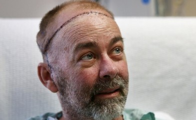 نجاح أول عملية لزراعة جمجمة وفروة رأس