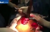 جراحين يستخرجون سمكة بطول متر من أمعاء رجل برازيلي..!!