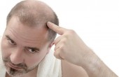 علاج-تساقط-الشعر-للرجال-730x370.jpg