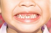 teeth-22032016-002.jpg