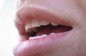 دراسة: نسب الأحماض العالية في المشروبات تسبب اهتراء الأسنان