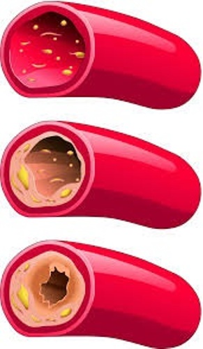 لعلاج انسداد الشرايين منزلياً عليكم بالثوم والحامض