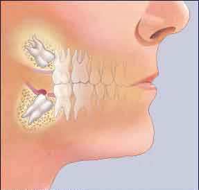 متى تستدعي الحال خلع ضرس العقل؟