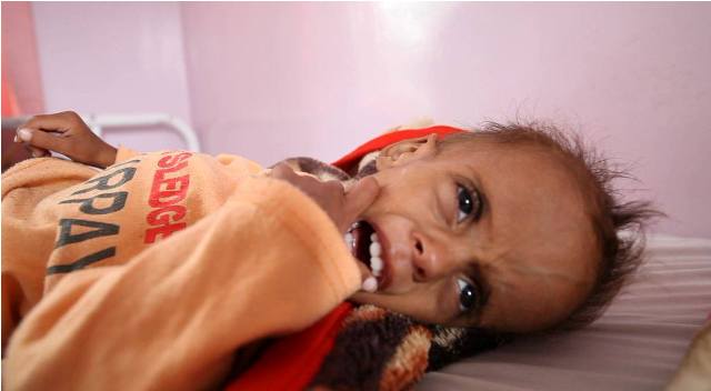 يونيسف: طفل يمني يموت كل 10 دقائق لأسباب يمكن الوقاية منها