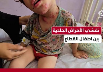 أطفال غزة يعانون أمراضاً جلدية.. مراسل فلسطين اليوم يرصد حالة الطفلة سلا عزام