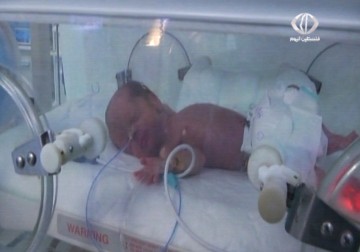 سيدة من غزة تلد 4 توائم في مشفى متخصص – 5 – 7 – 2015 - أمون الشيخ