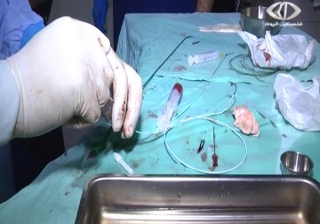 قسم قسطرة القلب الوحيد مهدد بالتوقف بفعل نقص المستلزمات والادوية- أكرم دلول - 8 - 4 - 2016