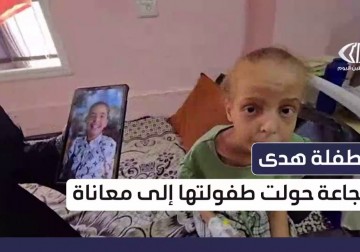 الطفلة هدى أبو النجا تغيرت ملامحها بسبب سوء التغذية الحاد وحساسية القمح في قطاع غزة