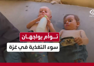 التوأم لين وليان يواجهان سوء التغذية وفقر الدم وسط غياب الحليب والمساعدات