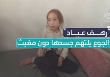  طفلة تذبل بصمت بسبب سوء التغذية وعجز المنظومة الصحية