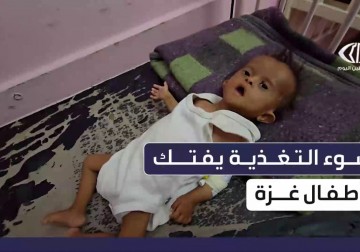 تصاعد حالات سوء التغذية بين أطفال غزة وسط الحصار والعدوان الإسرائيلي المستمر