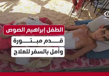 الطفل إبراهيم الصوص فقد قدمه خلال العدوان على #غزة ويحتاج إلى السفر لتركيب طرف صناعي