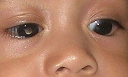 تخلى الوالدان كل واحد عن عين .. ليرى ابنهما!.