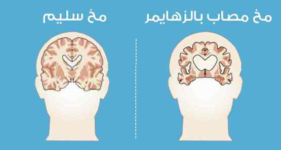 دراسة.. النوم الجيد يقي كبار السن من الزهايمر