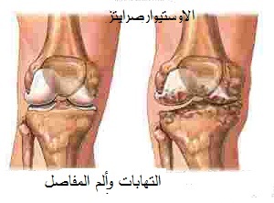 ما سبب تآكل غضاريف المفاصل؟