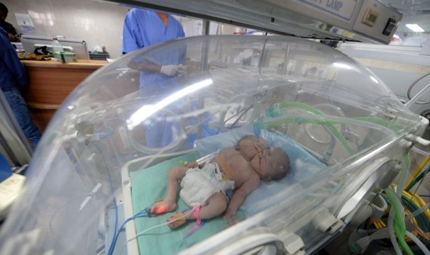 ولادة توأمين سياميين في غزة