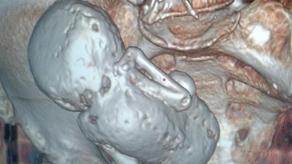 جزائرية عمرها 73 تحمل جنيناً عمره 35 سنة!