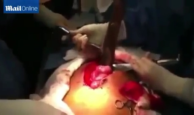 جراحين يستخرجون سمكة بطول متر من أمعاء رجل برازيلي..!!
