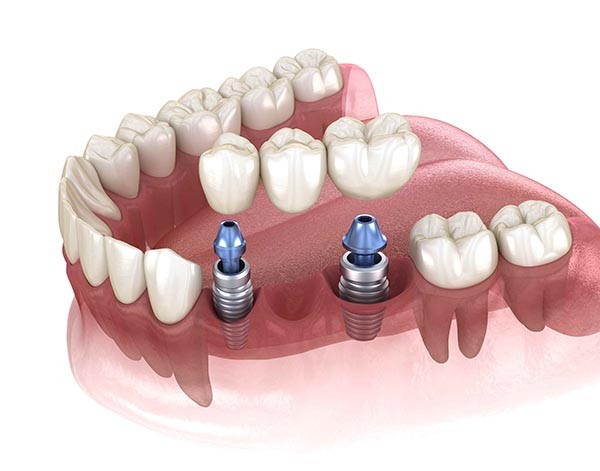 Dental-Implant-Supported-3-Unit-Bridge.jpg