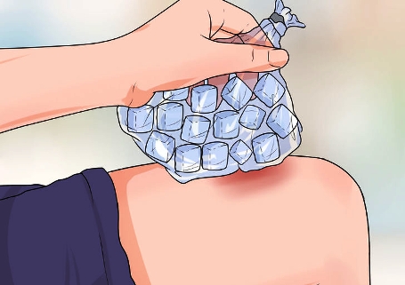 التخلص من الكدمات بشكل سريع