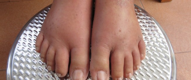 tbl_diseases_disease_221_124addc3db7-48c2-4550-9a83-960dce7f4000.jpg