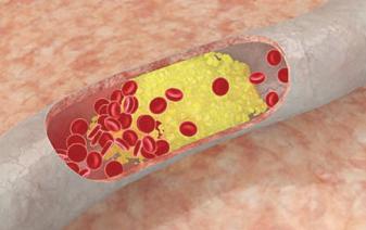 ارتفاع الكوليسترول يساعد على انتشار السرطان بالجسم