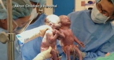 أميركية تضع توأمين تمسكان بيد بعضهما