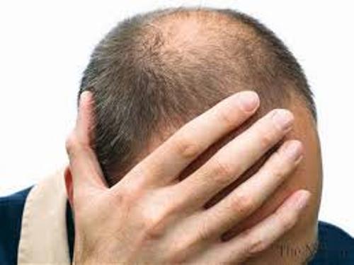 تخلصوا من الصلع بزيت الزيتون و.. البصل