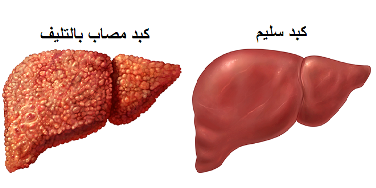 التليّف يفقد أعضاء الجسم وظائفها