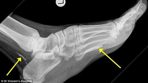 دودة تعيش  في قدم رجل لمدة 4 سنوات 