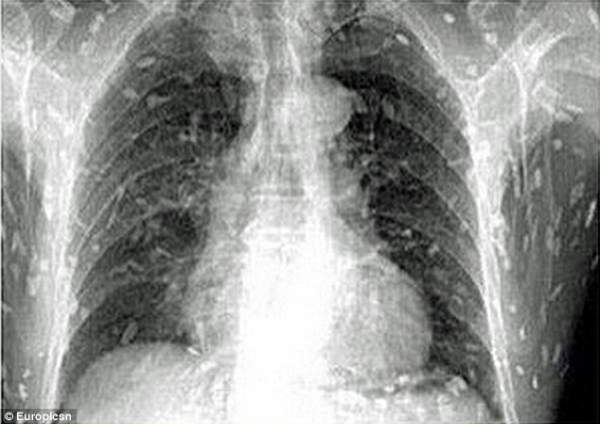 مئات الديدان تغزو جسم صيني تناول وجبة 