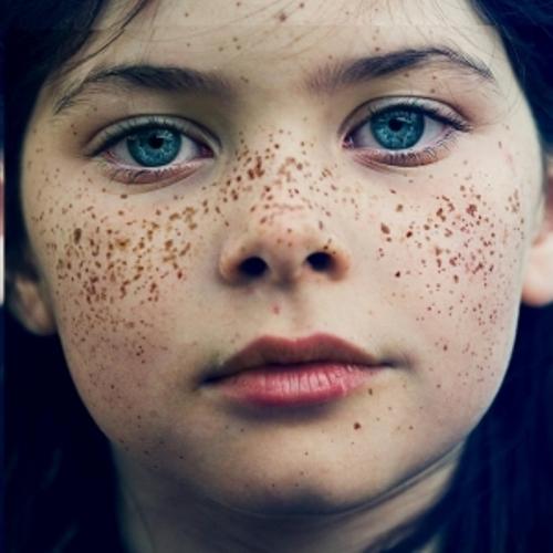 8 طرق متفرقة تخلصك من النمش