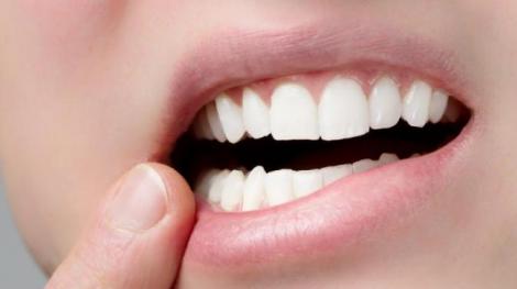 وصفات طبيعية تعالج تقرحات الفم