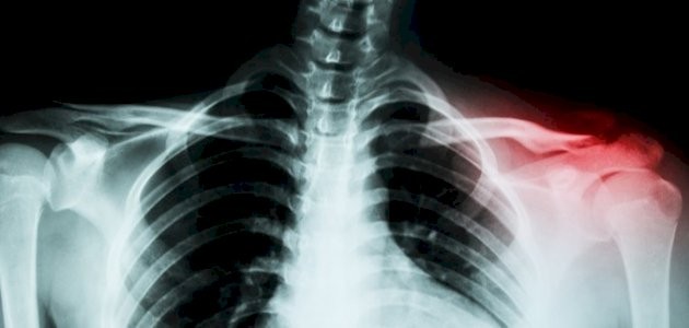 أسباب_ألم_عظمة_الترقوة.jpg