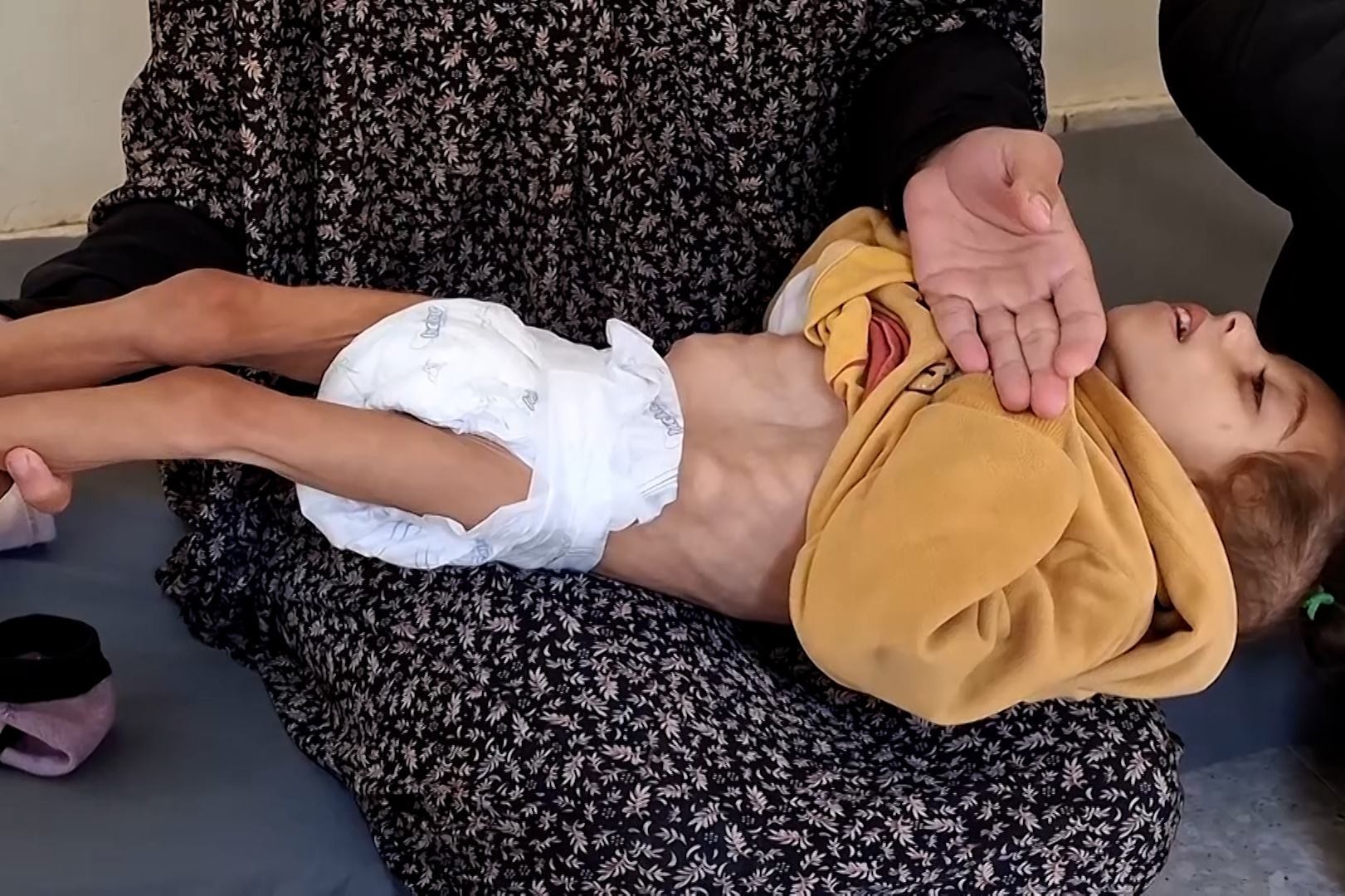 وفاة طفل سوء تغذية.jpg